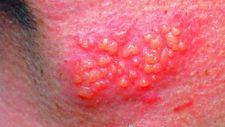 Herpesviirusnakkus Herpesviirusnakkus