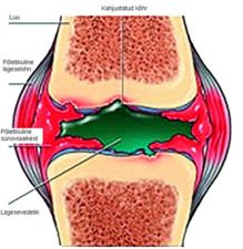 Reumatoidartriit Reumatoidartriit