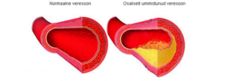 Oblitereeriv endarteriit Oblitereeriv endarteriit
