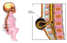 Spina bifida