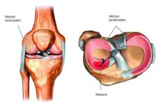 Meniskikahjustus