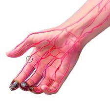Oblitereeriv endarteriit Oblitereeriv endarteriit